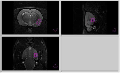 From Allostatic Load to Allostatic State—An Endogenous Sympathetic Strategy to Deal With Chronic Anxiety and Stress?